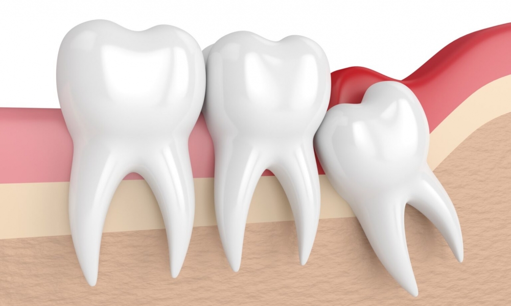 Wisdom Teeth Extraction 