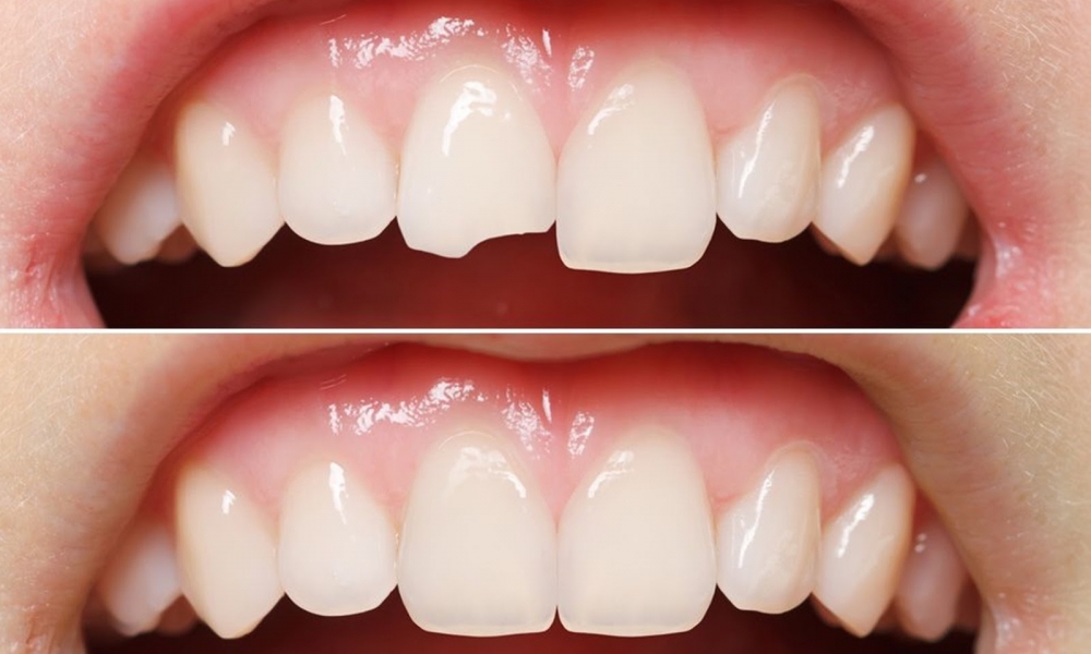 Aesthetic Fillings (Composite)