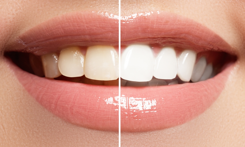 Teeth Whitening (Bleaching)