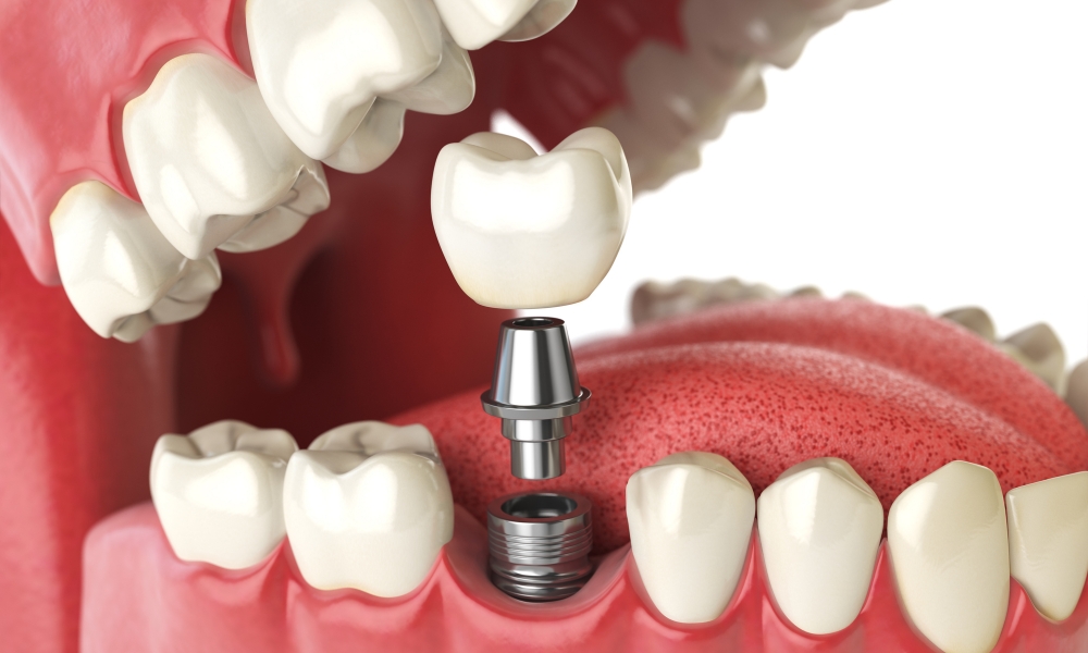 Implant Treatment
