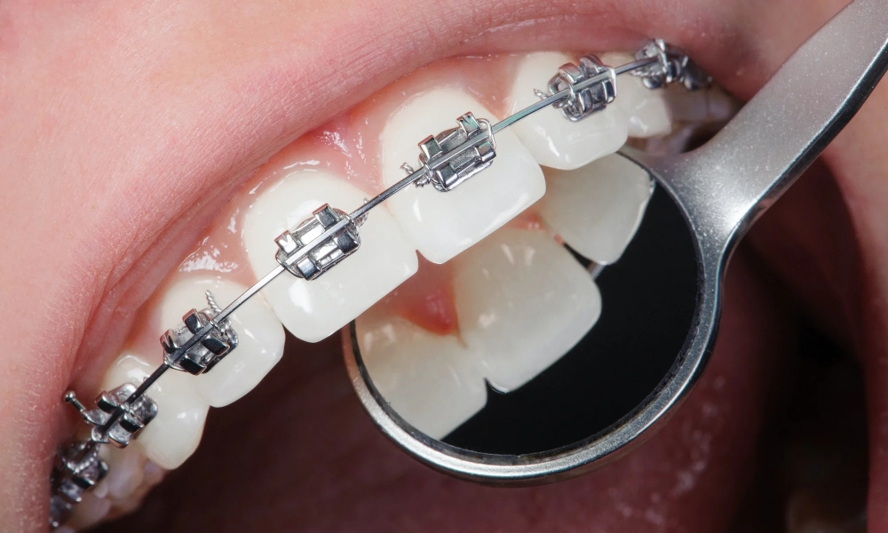 Orthodontics / Braces Treatment