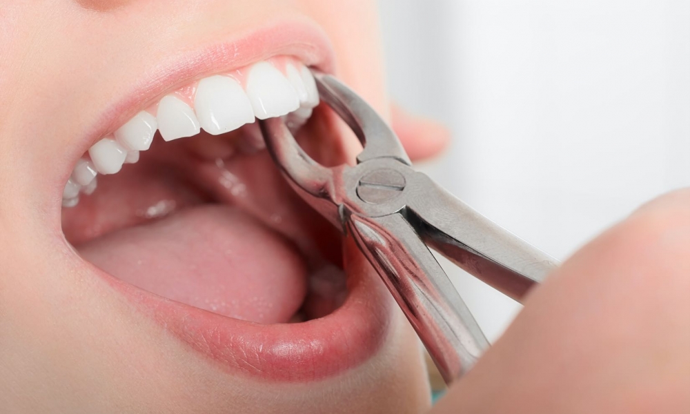 Tooth Extraction